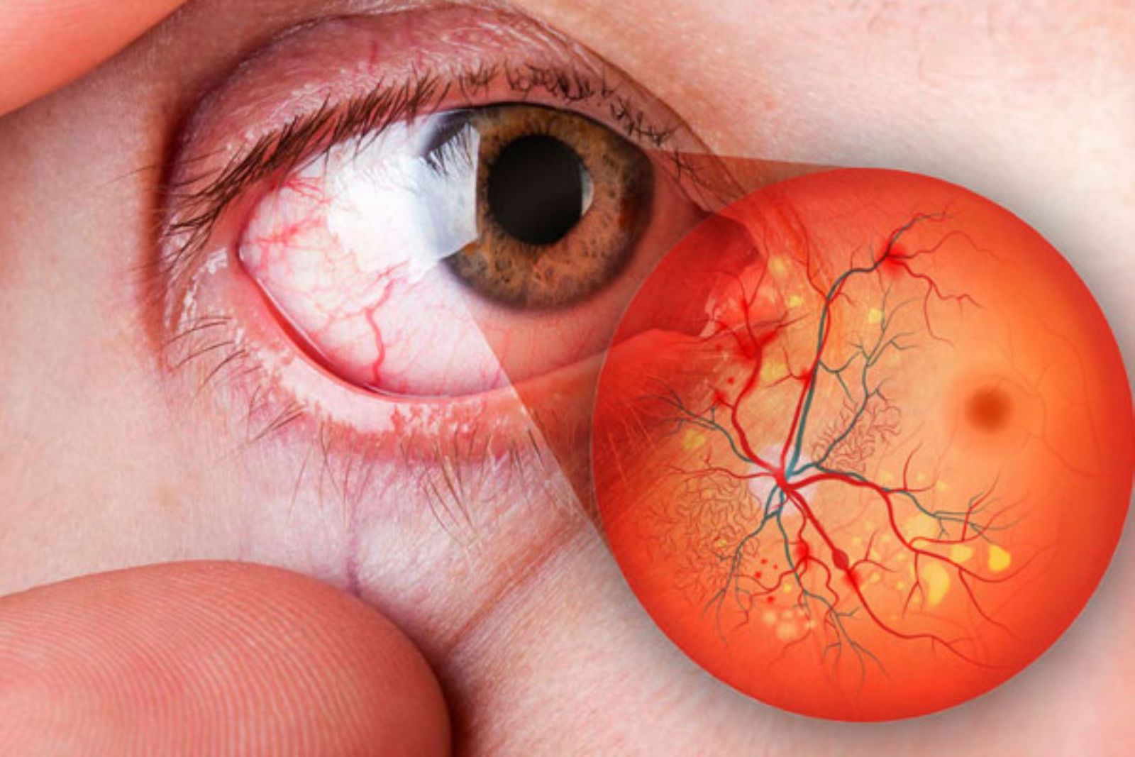 Oclusiones vasculares de la retina y  edema macular