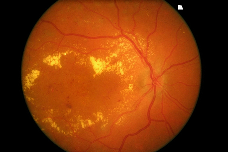 Oclusiones vasculares de la retina y  edema macular