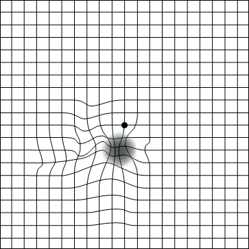Agujero macular
