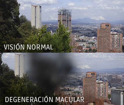 Degeneración macular relacionada a la edad  - DMRE