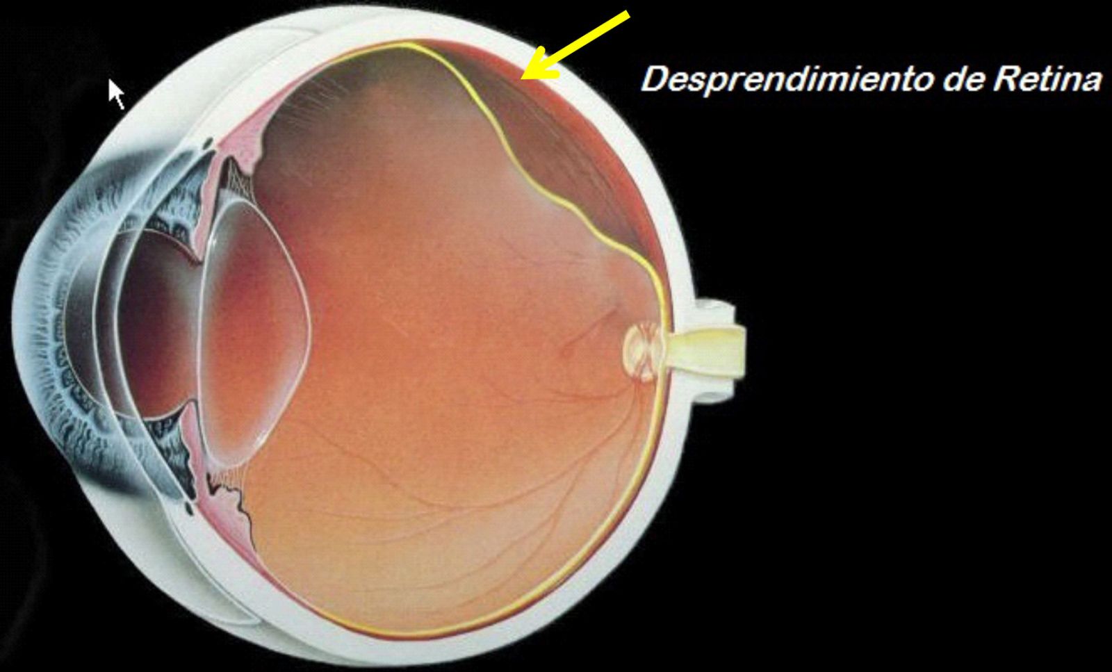 Desprendimiento de retina