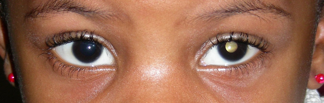 Retinoblastoma