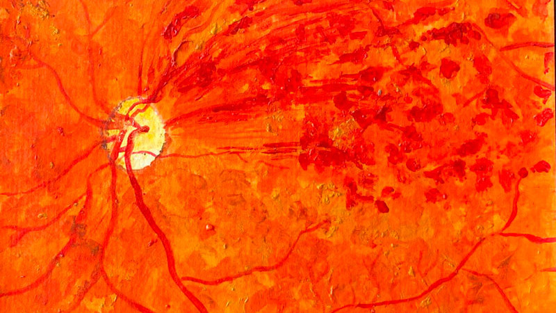 Oclusión de rama venosa de la retina